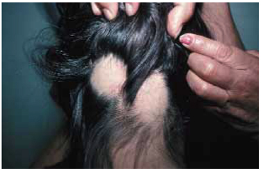 Bald spots on a young girl | MDedge Family Medicine