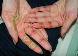 A patient with breast cancer and a rash on her hands and feet