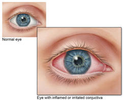 Sublingual Medication Efficacious for Allergic Rhinoconjunctivitis | MDedge