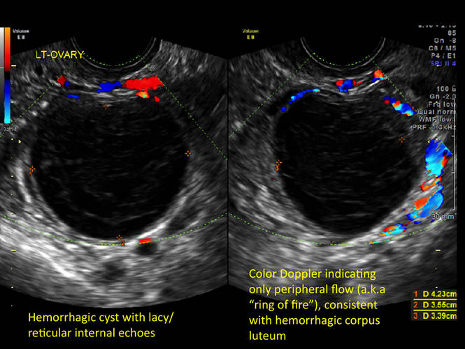 Transvaginal Ultrasound Ovarian Cysts Ovarian Cysts Functional Or Transvaginal Ultrasound Ovarian Cysts Ovarian Cysts Functional Or