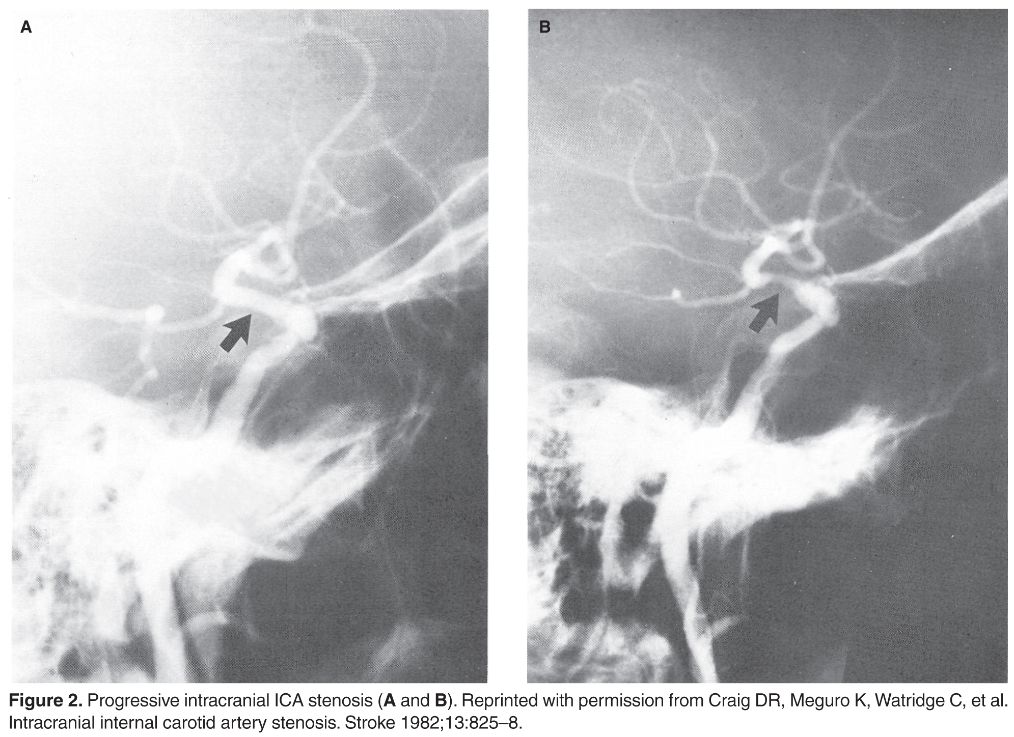 icad medical stroke