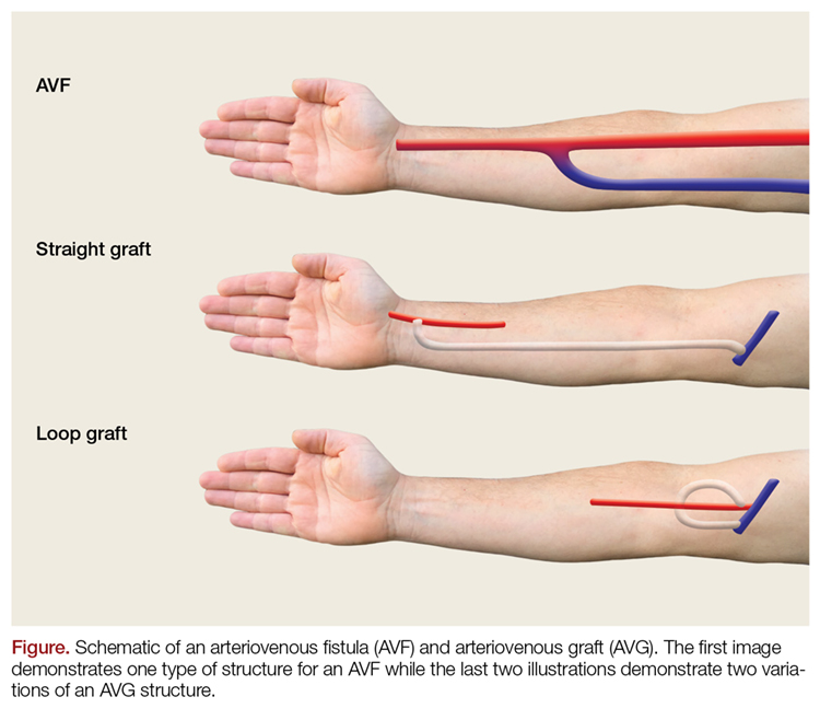 Arm Port Insertion - Kent Vascular Access