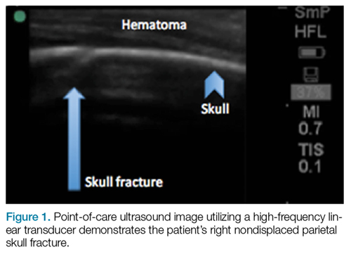Identifying Pediatric Skull Fracture Using Point of Care Ultrasound 
