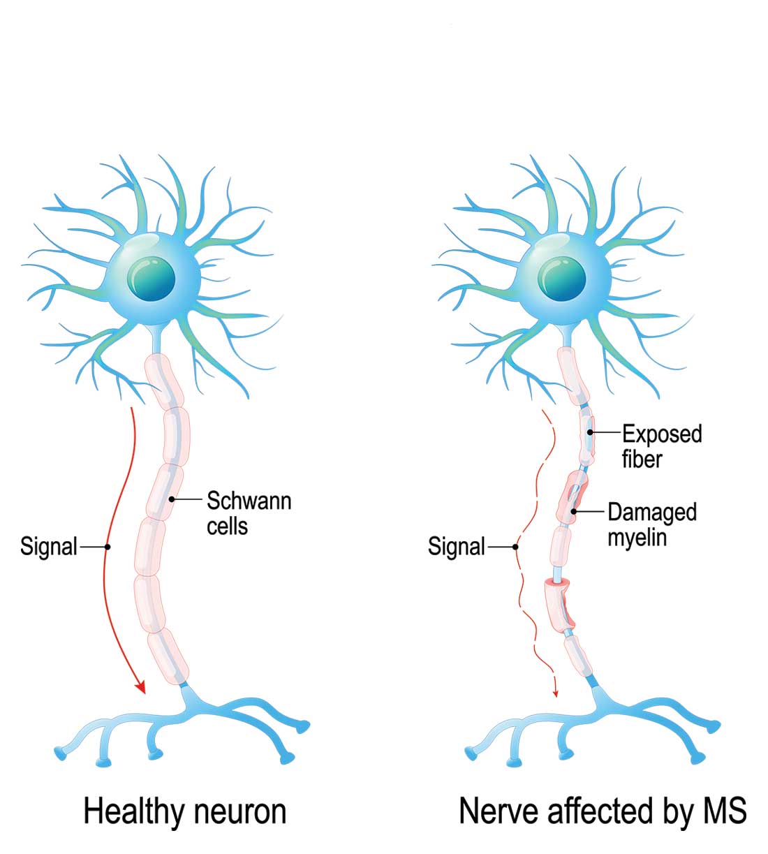 Identifying and Managing MS Relapse