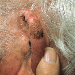 Brown spot on ear