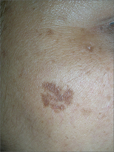 Brown Spots On Your Skin