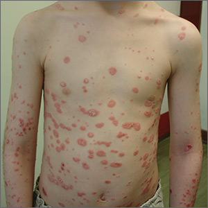 Rapid-onset rash in child