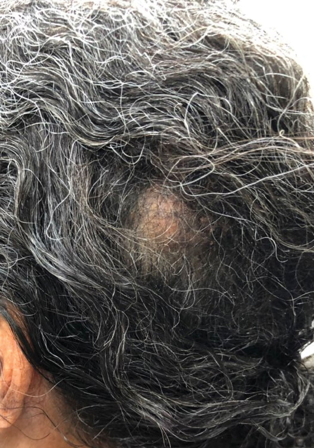 A 6.2×6.0-cm flesh-colored nodule on the scalp was examined prior to Mohs micrographic surgery.