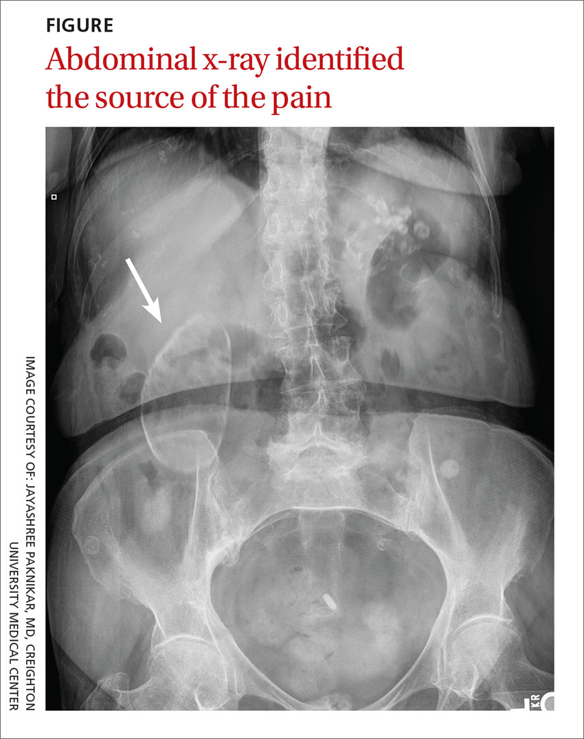 Recurrent Right Upper Quadrant Abdominal Pain MDedge Family Medicine