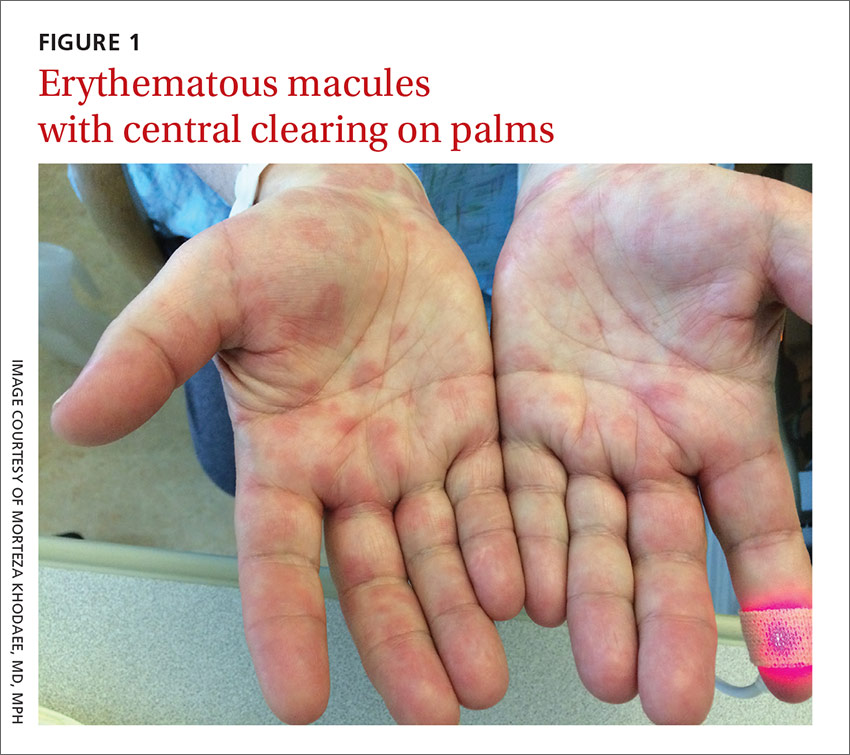 Mildly pruritic palmar rash MDedge Family Medicine