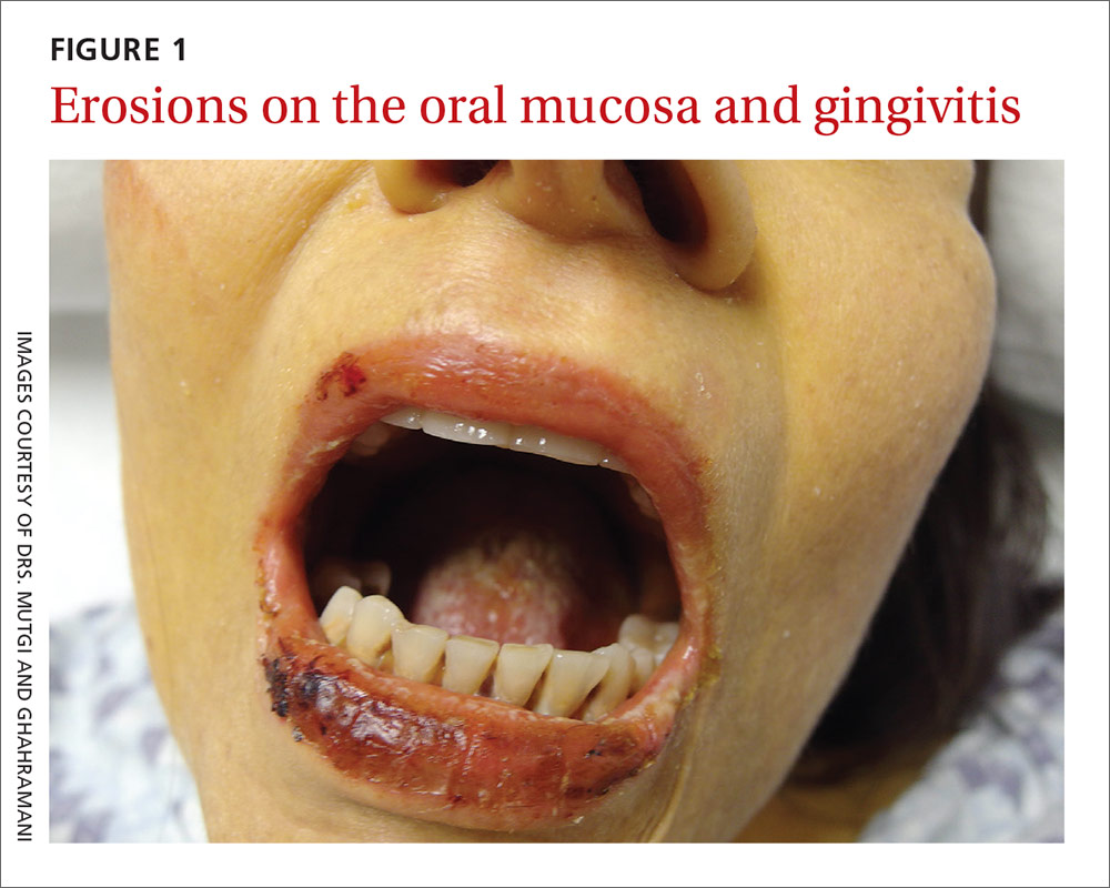 Erosions on the oral mucosa and gingivitis image