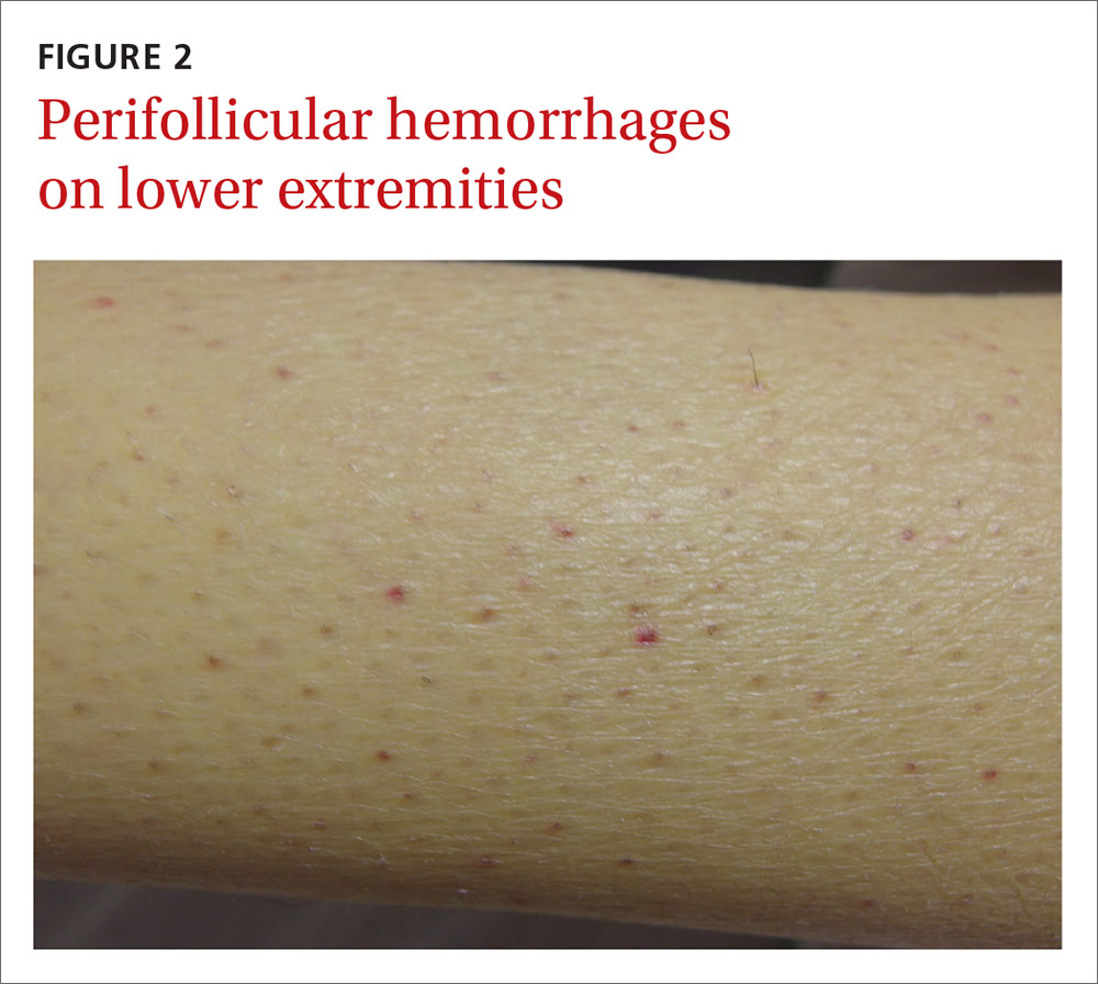 Perifollicular hemorrhages on lower extremities image