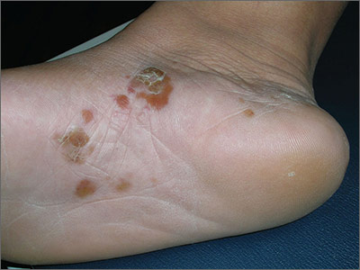 Tinea Pedis Blisters