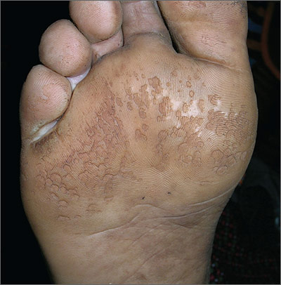 Malodorous, itchy feet  MDedge Family Medicine