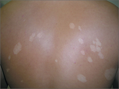White spots on back | MDedge Family Medicine