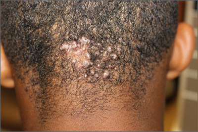 folliculitis scalp african american