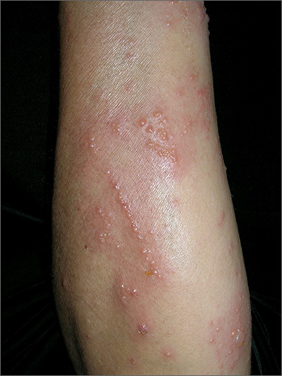 Intensely pruritic rash | MDedge Family Medicine