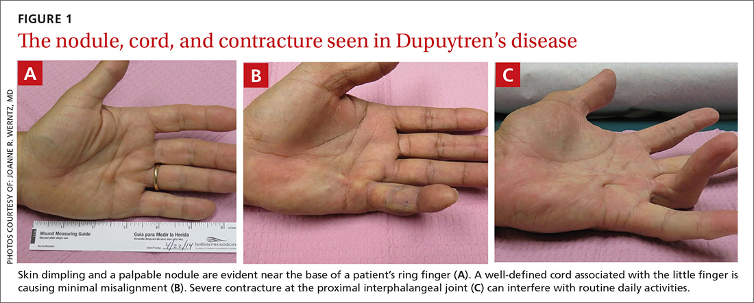 Dupuytren Contracture: Causes, Symptoms & Treatment