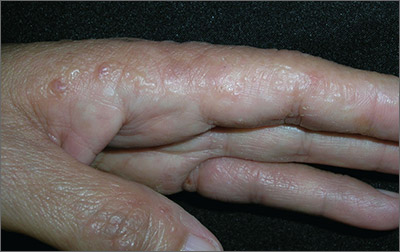 rashes on hands