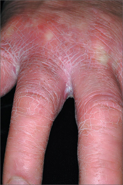 Ræv halt kompensation Painful, red hands | MDedge Family Medicine