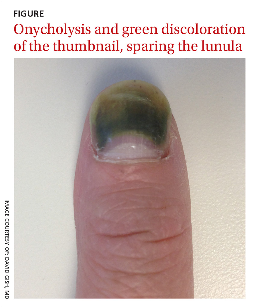 Green Fingernail MDedge Family Medicine