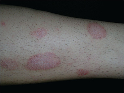Dry Spots On Lower Legs Mdedge Family Medicine