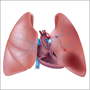 What’s the best treatment setting for stable PE patients?