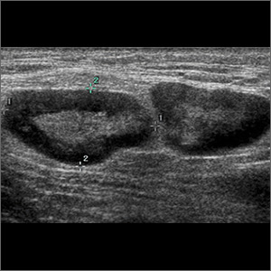 6-day history of fever • groin pain and swelling • recent hiking trip in Colorado • Dx?