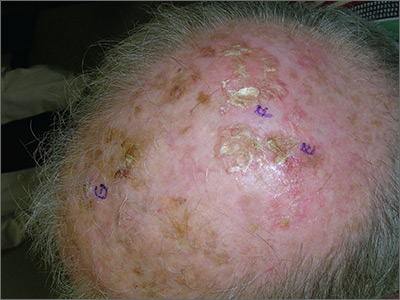 skin cancer scalp treatment