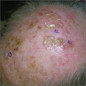 Growths on scalp