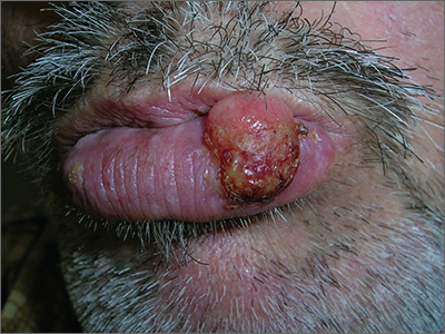 Growing lesion on lip