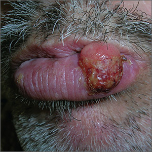 Growing lesion on lip