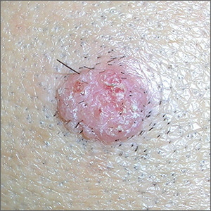 Wart on scalp