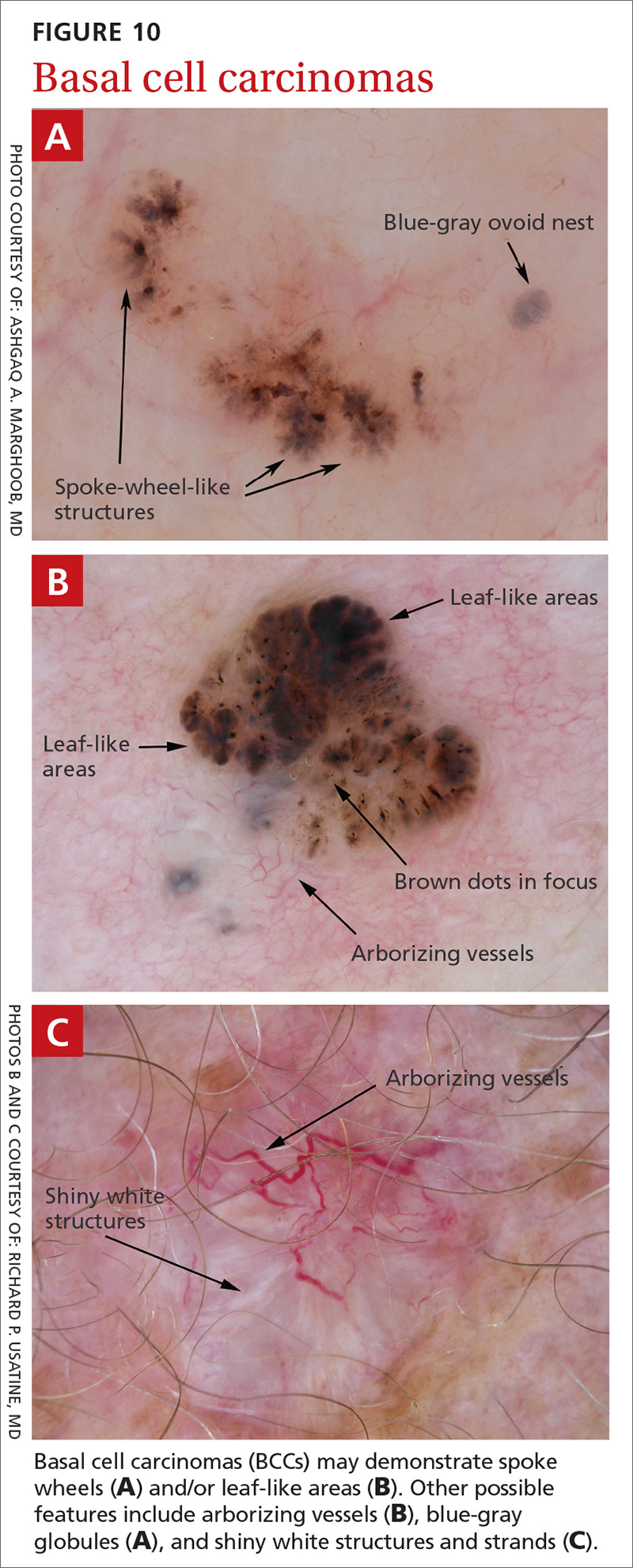 Dermoscopy Features Associated With Subtypes Of Basal