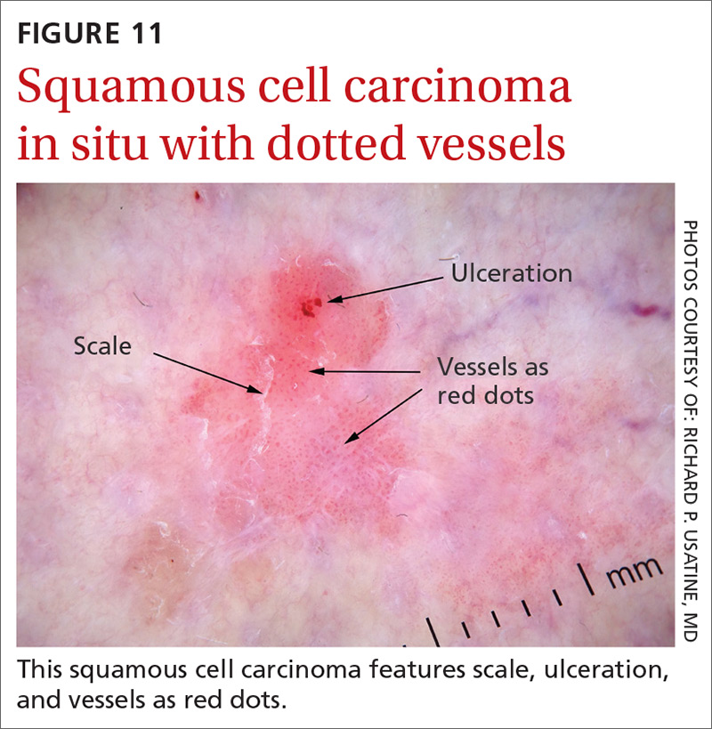 Squamous cell carcinoma in situ with dotted vessels