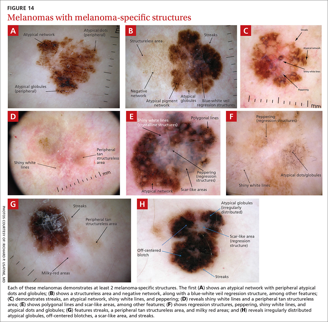 Melanomas with melanoma-specific structures