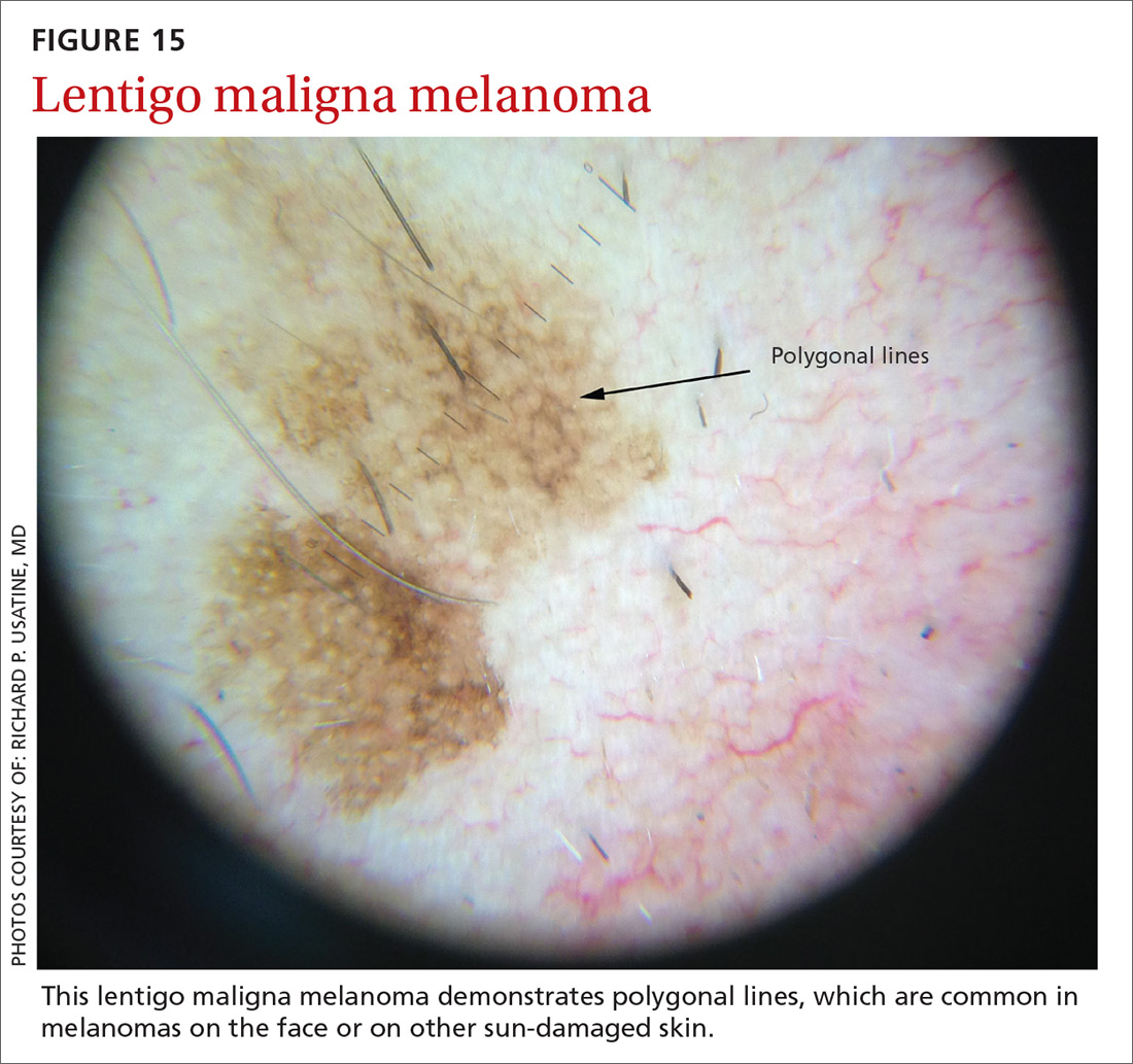 Lentigo maligna melanoma