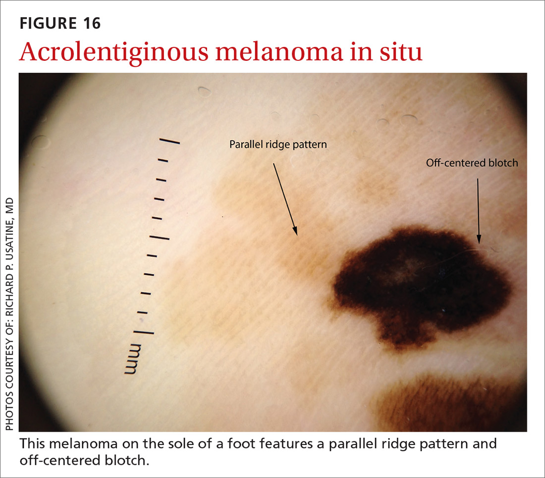 Acrolentiginous melanoma in situ