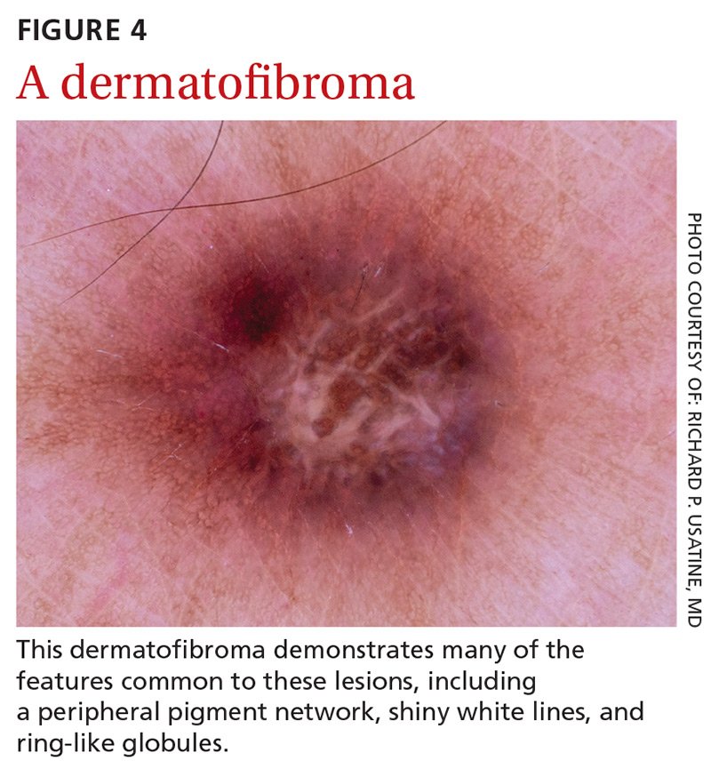 Dermoscopic feature of dermatofibroma of the patient. Central white