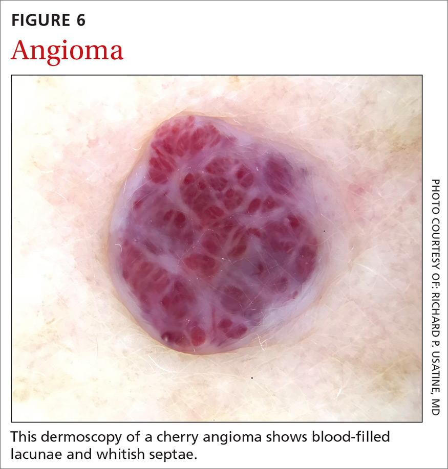 Angioma