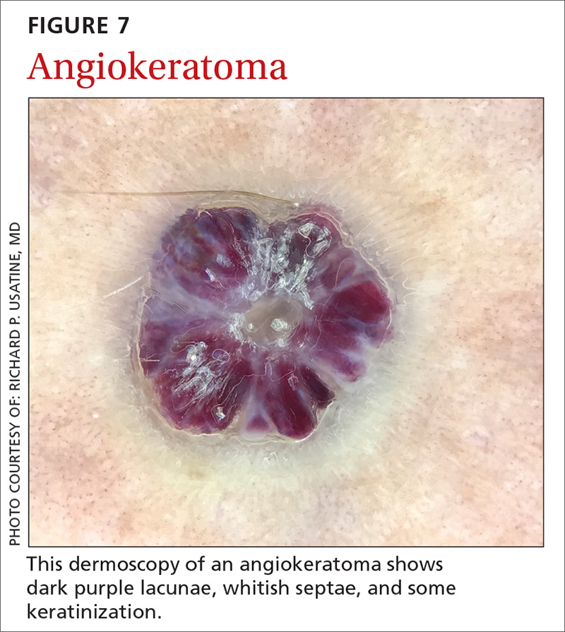 Angiokeratoma