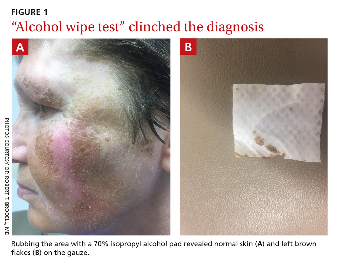 “Alcohol wipe test” clinched the diagnosis