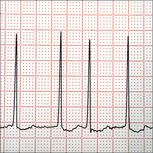 Does left atrial appendage closure reduce stroke rates as well as oral anticoagulants and antiplatelet meds in A-fib patients?