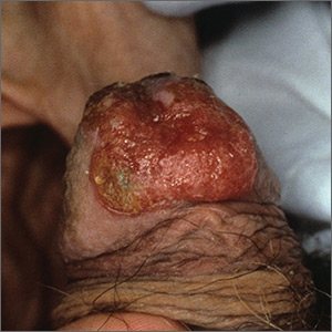 Growing lesion