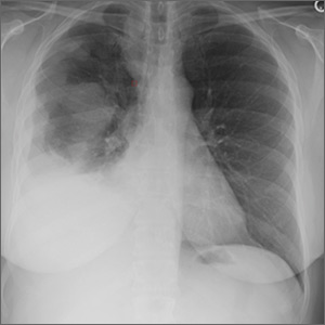 History of melanoma in situ • dyspnea • rib pain • Dx?