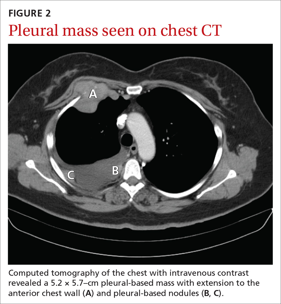 Pleural mass seen on chest CT