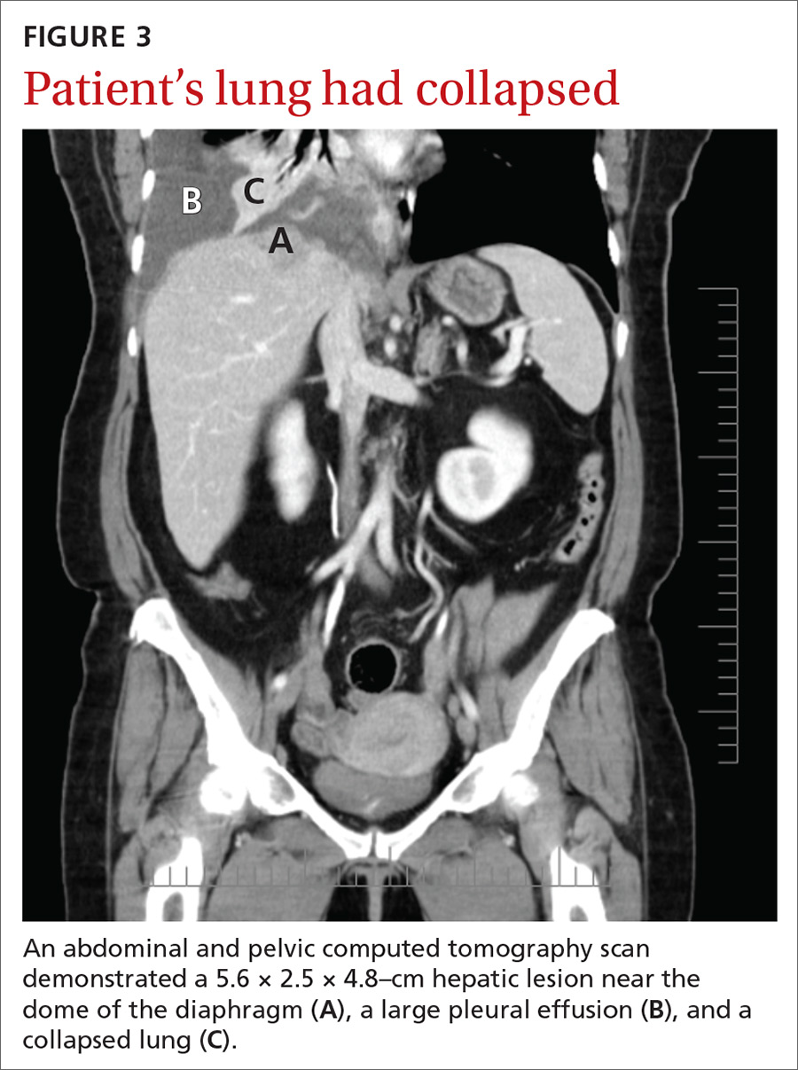 Patient’s lung had collapsed