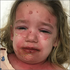 A young girl with a painful rash