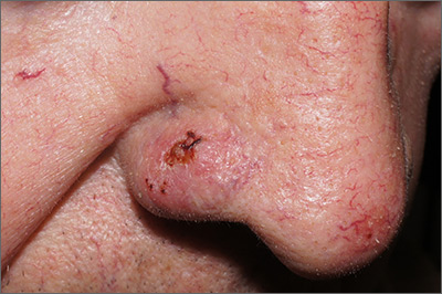 squamous cell carcinoma nose