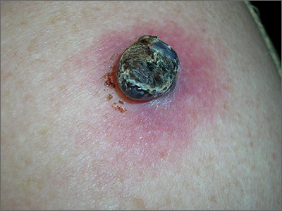 Black lesion on arm